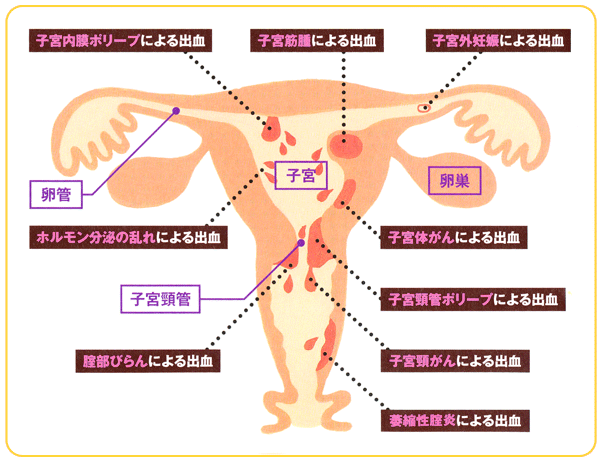 茶色 不正 出血